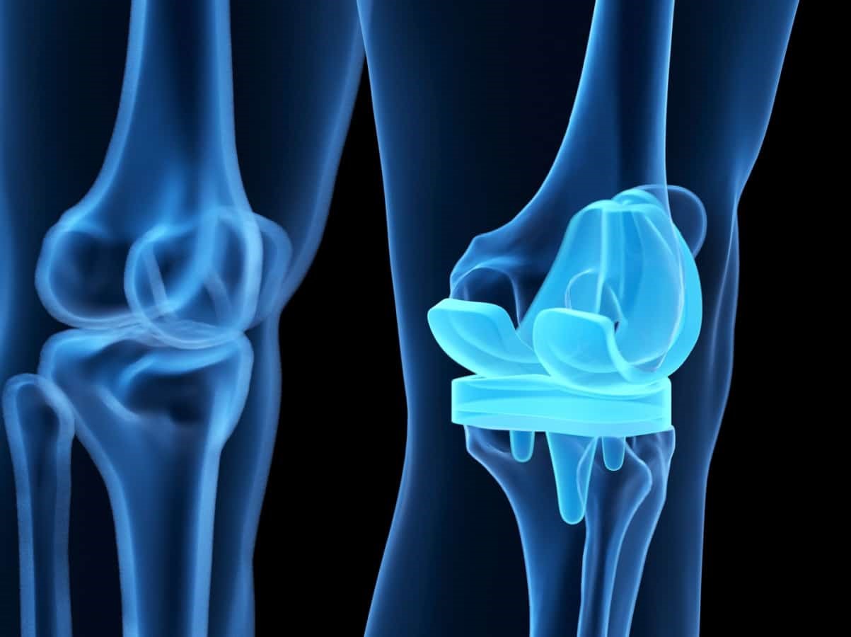 Things to Know About Knee Replacement